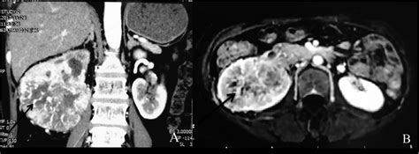  Kidney Parasite: Một Kẻ Trốn Trong Sóng Ngầm Của Hệ Thống Khí Quản